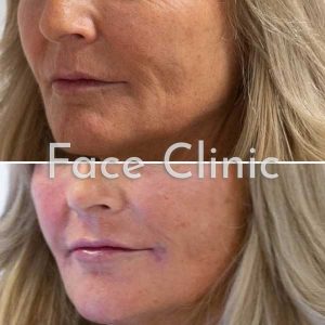 Chin and Jaw Line Filler